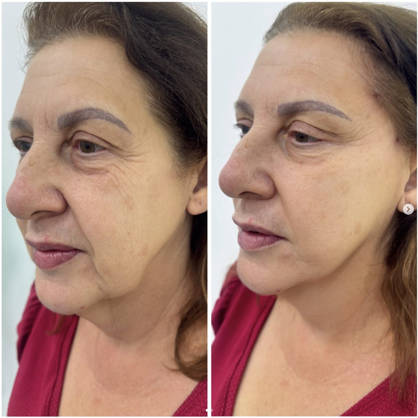 Antes e depois de preenchimento labial