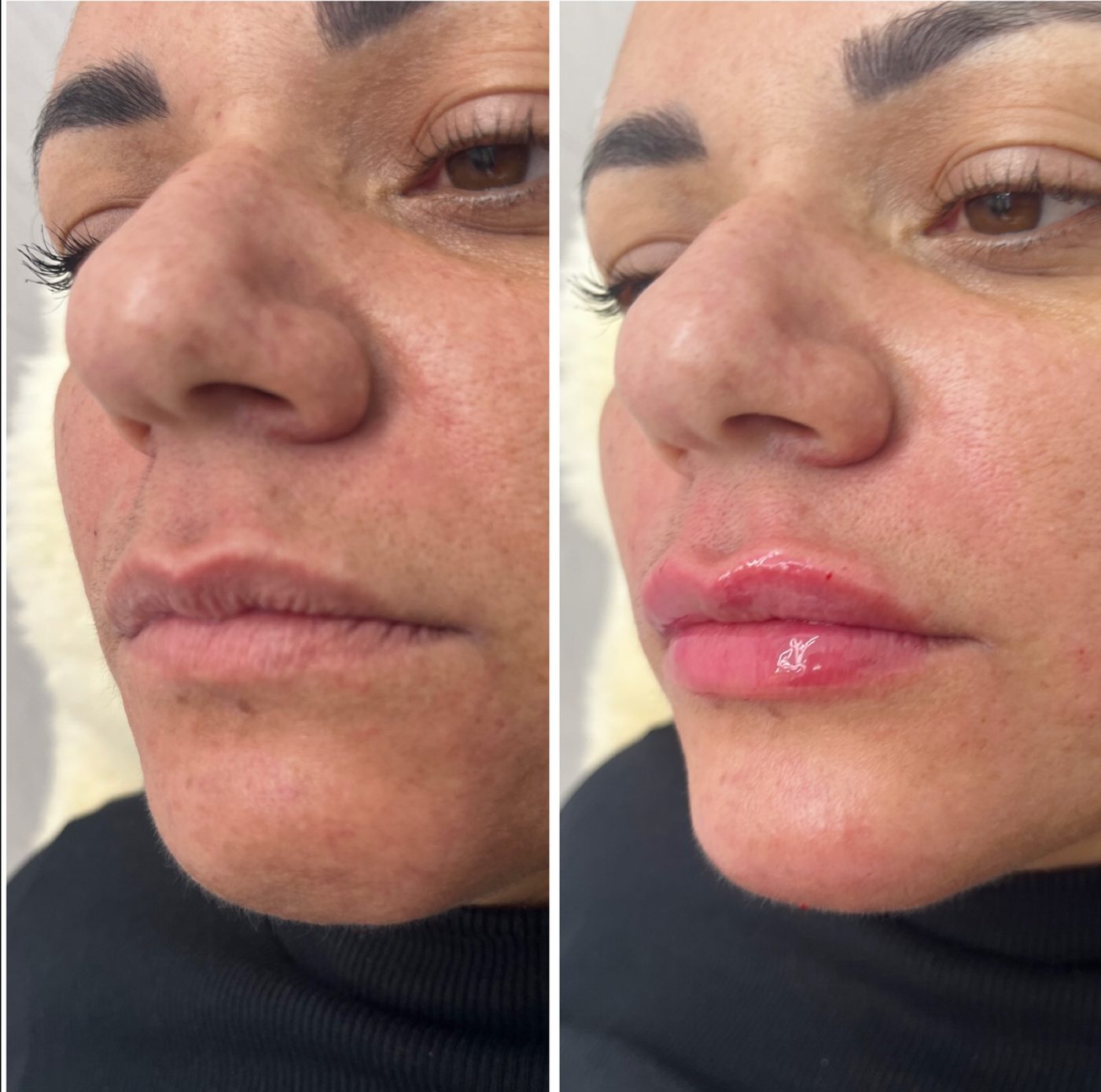 Antes e depois de procedimento facial
